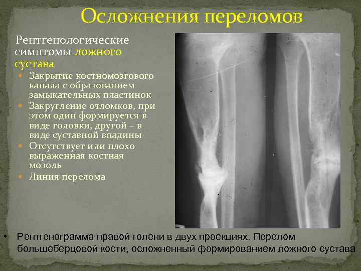 Осложнения переломов Рентгенологические симптомы ложного сустава Закрытие костномозгового канала с образованием замыкательных пластинок Закругление