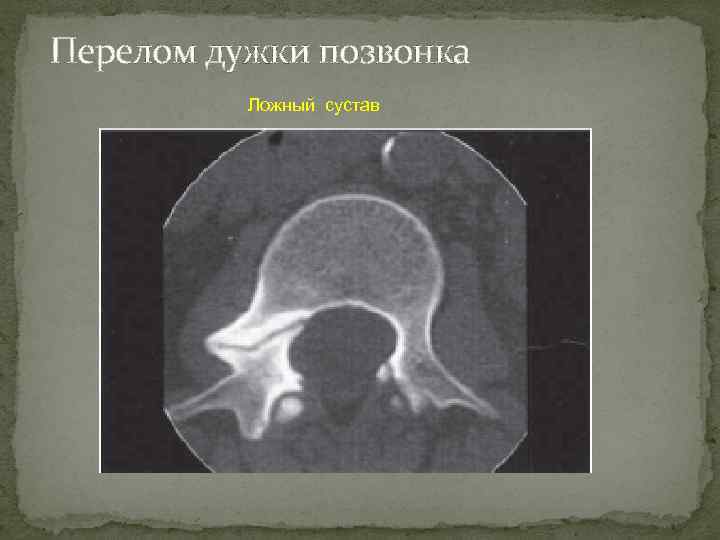Перелом дужки позвонка Ложный сустав 