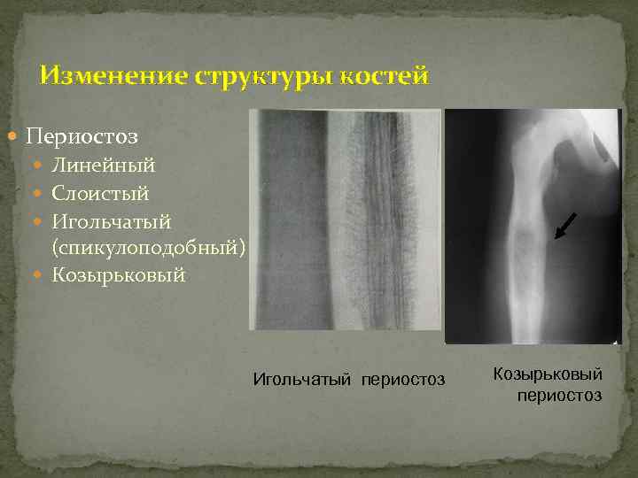 Изменение структуры костей Периостоз Линейный Слоистый Игольчатый (спикулоподобный) Козырьковый Игольчатый периостоз Козырьковый периостоз 