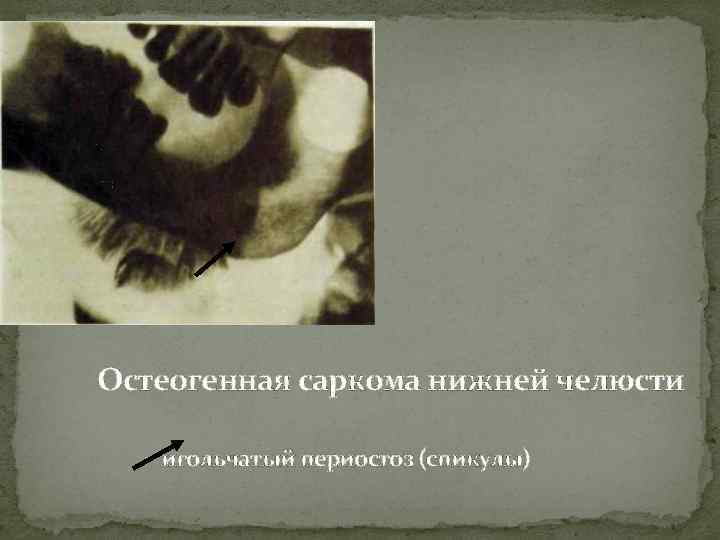 Остеогенная саркома нижней челюсти - игольчатый периостоз (спикулы) 