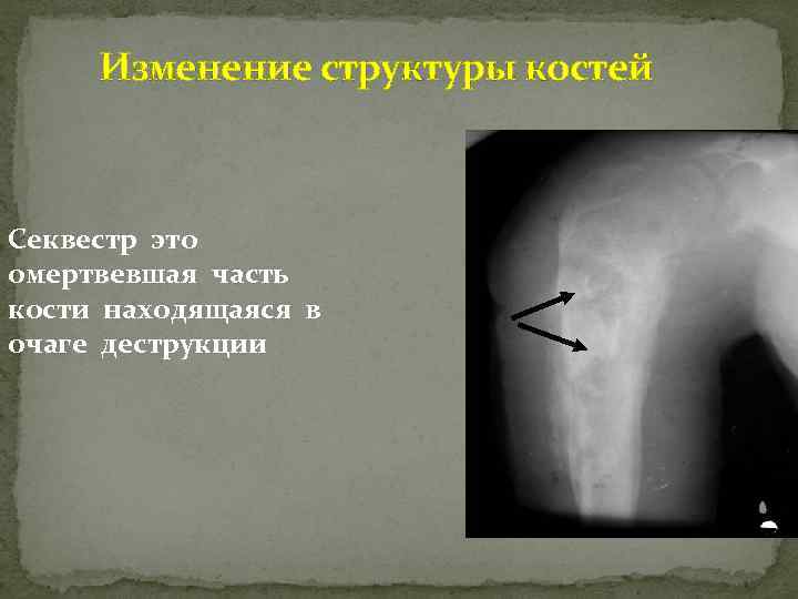 Изменение структуры костей Секвестр это омертвевшая часть кости находящаяся в очаге деструкции 