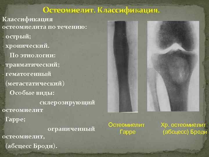 Остеомиелит. Классификация остеомиелита по течению: - острый; - хронический. По этиологии: - травматический; -
