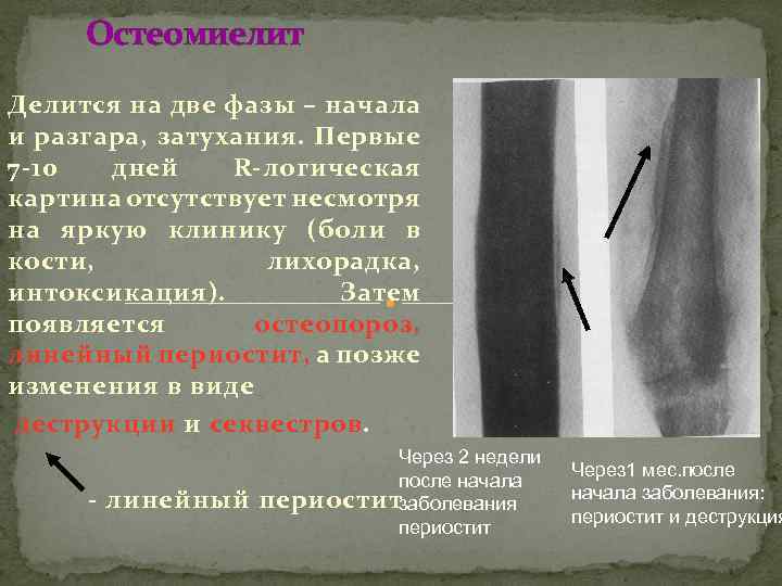 Остеомиелит Делится на две фазы – начала и разгара, затухания. Первые 7 -10 дней