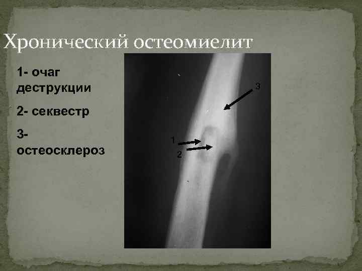 Хронический остеомиелит 1 - очаг деструкции 3 2 - секвестр 3 остеосклероз 1 2