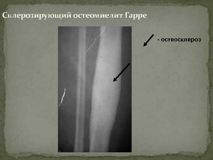 Склерозирующий остеомиелит Гарре - остеосклероз 