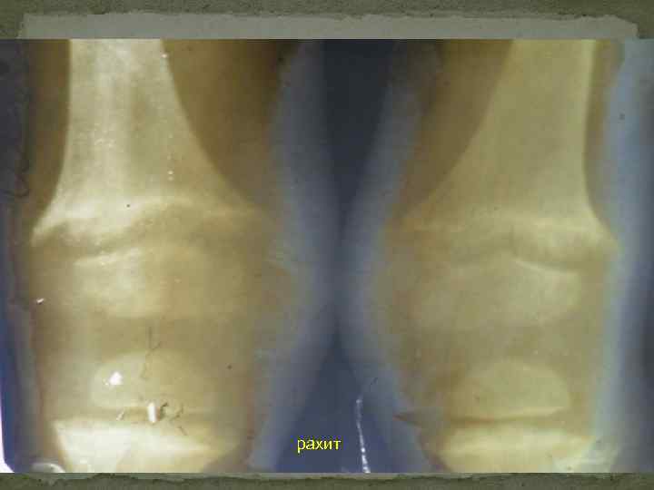 рахит 