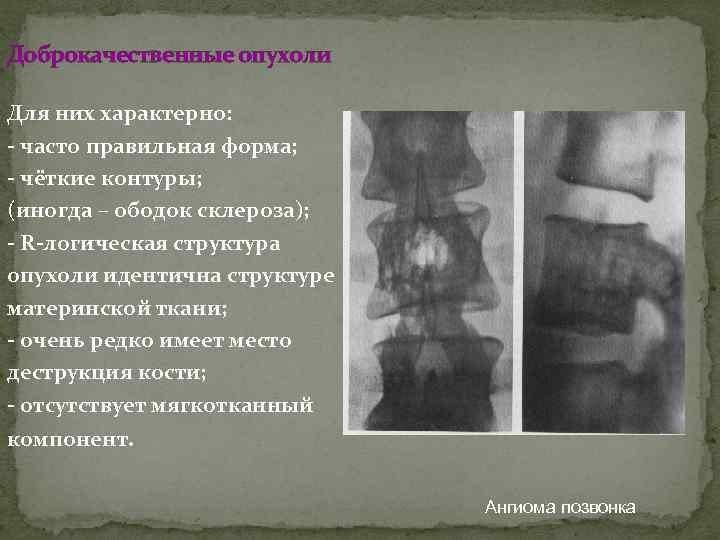 Доброкачественные опухоли Для них характерно: - часто правильная форма; - чёткие контуры; (иногда –