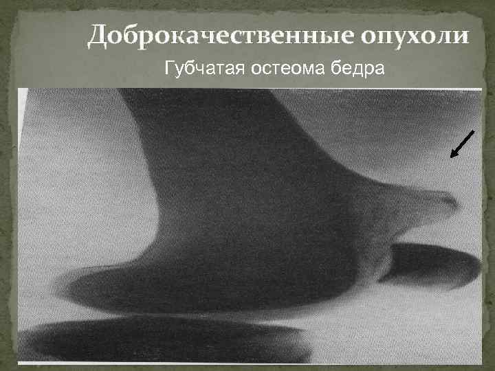 Доброкачественные опухоли Губчатая остеома бедра 