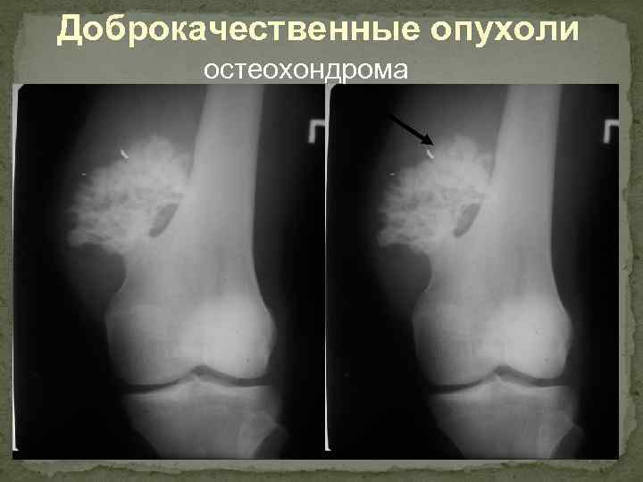 Доброкачественные опухоли остеохондрома 