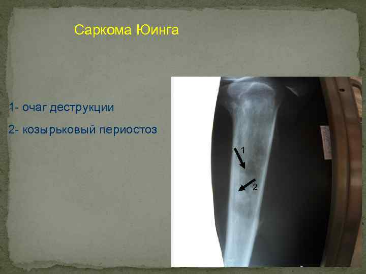 Саркома Юинга 1 - очаг деструкции 2 - козырьковый периостоз 1 2 
