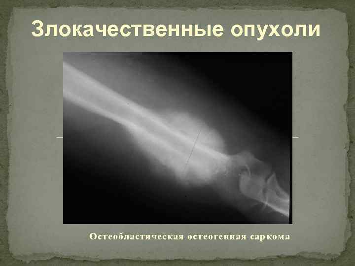 Злокачественные опухоли Остеобластическая остеогенная саркома 