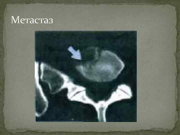 Метастаз 