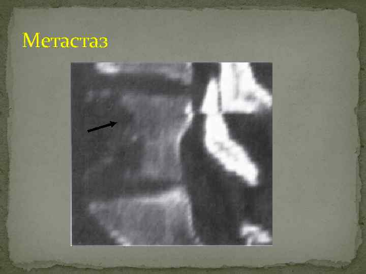 Метастаз 