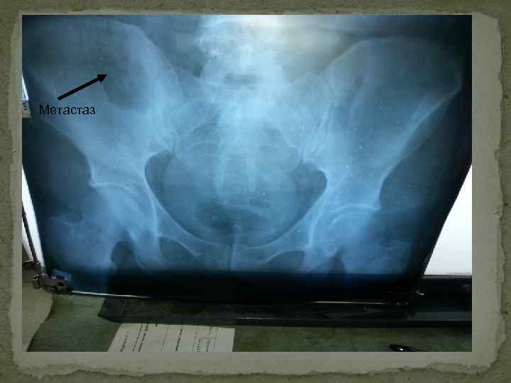 Метастаз 
