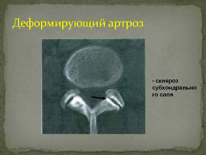 Деформирующий артроз - склероз субхондрально го слоя 