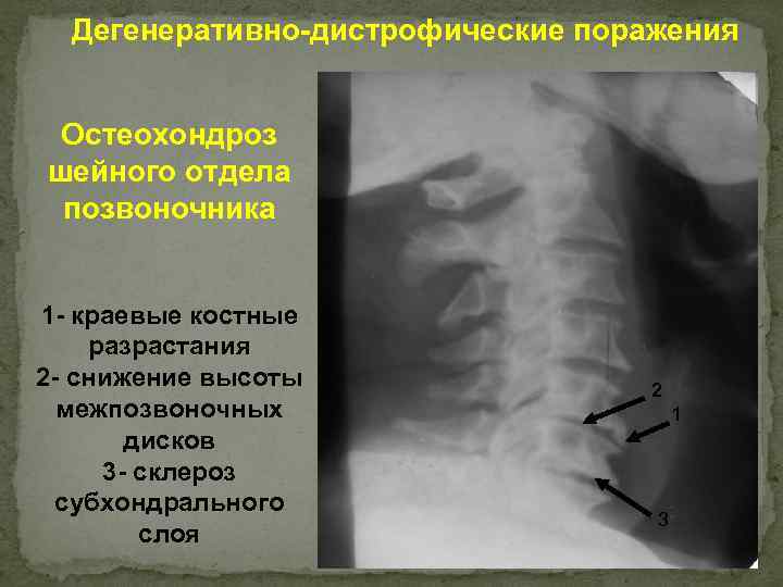 Дегенеративно-дистрофические поражения Остеохондроз шейного отдела позвоночника 1 - краевые костные разрастания 2 - снижение