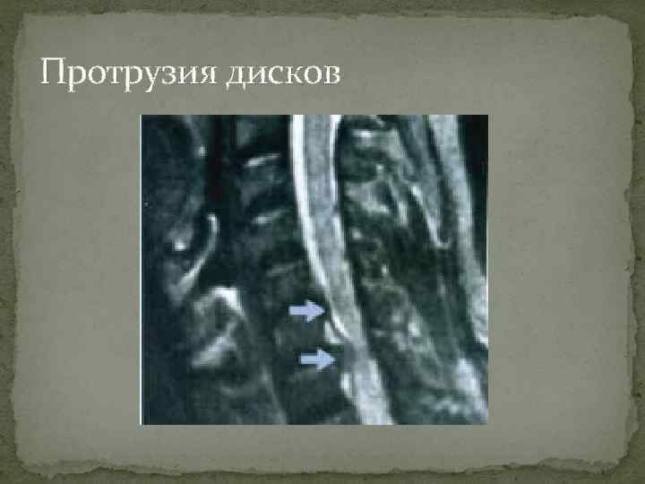 Протрузия дисков 