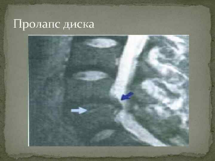 Пролапс диска 