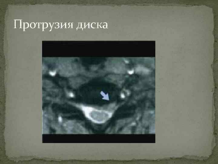 Протрузия диска 