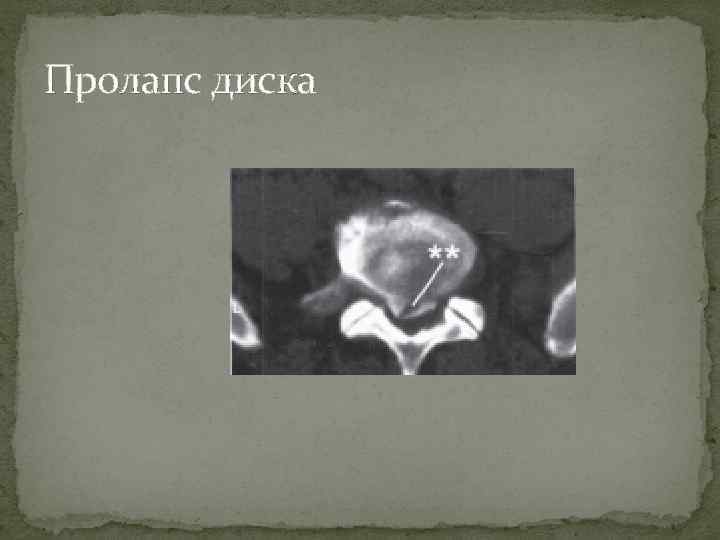 Пролапс диска 