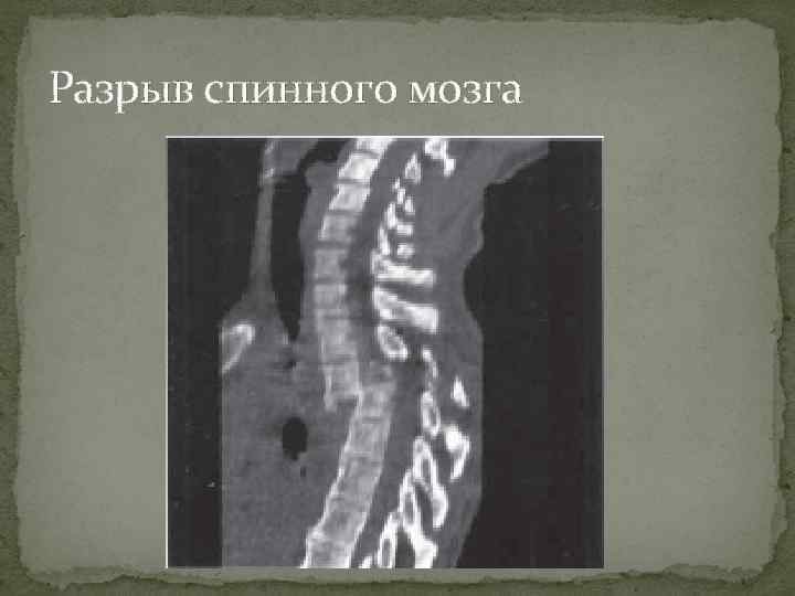 Разрыв спинного мозга 