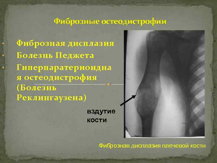 Фиброзные остеодистрофии • • • Фиброзная дисплазия Болезнь Педжета Гиперпаратериоидна я остеодистрофия (Болезнь Реклингаузена)