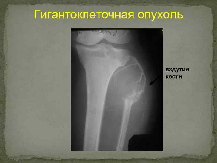 Гигантоклеточная опухоль вздутие кости 