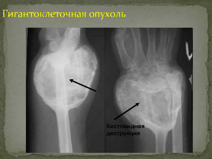 Гигантоклеточная опухоль Кистовидная деструкция 