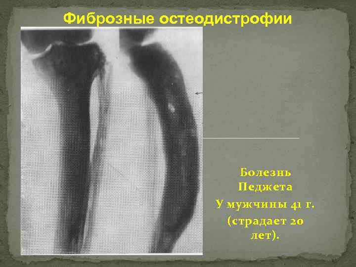 Фиброзные остеодистрофии Болезнь Педжета У мужчины 41 г. (страдает 20 лет). 