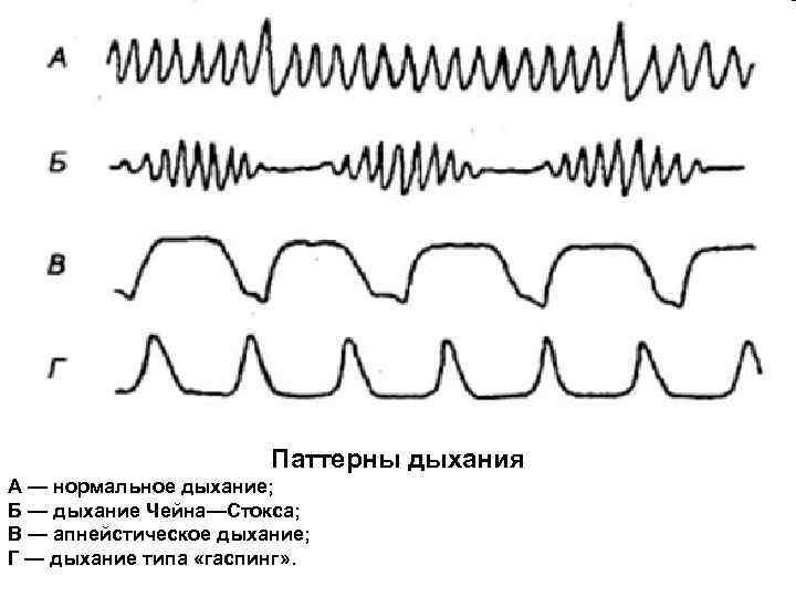 Нормальное дыхание. Патологические типы дыхания гаспинг. Паттерны дыхания. Апнейстическое дыхание. Дыхание типа гаспинг.