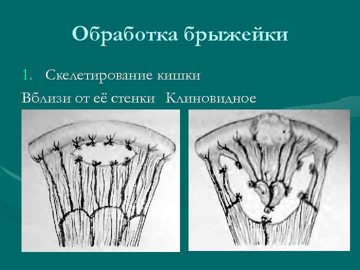 Обработка брыжейки 1. Скелетирование кишки Вблизи от её стенки Клиновидное 