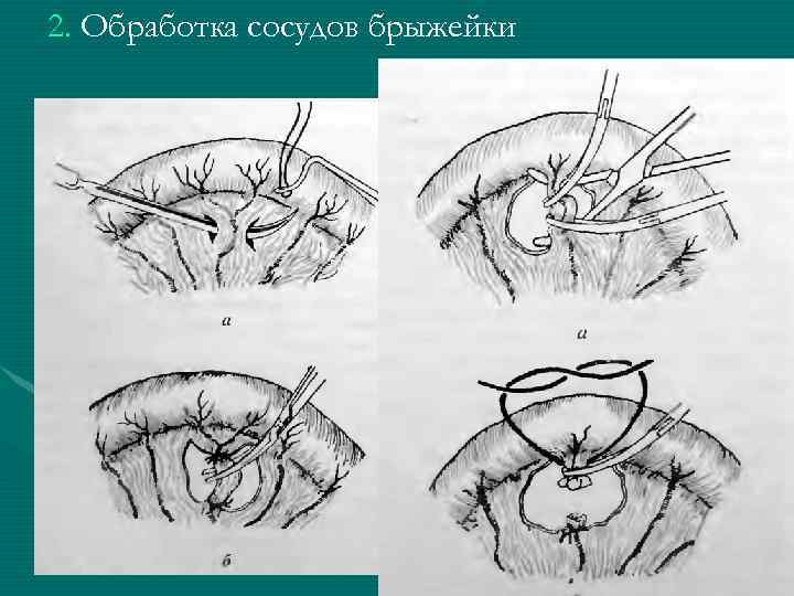 2. Обработка сосудов брыжейки 