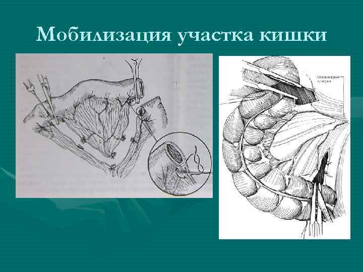 Мобилизация участка кишки 