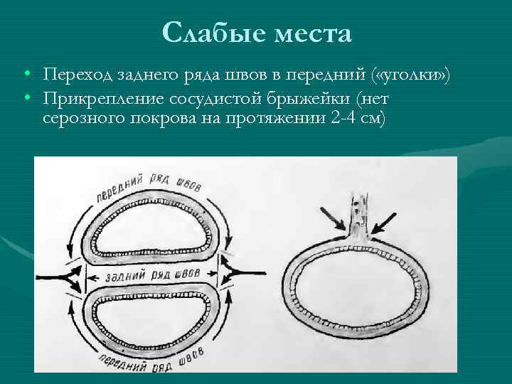 Слабые места • Переход заднего ряда швов в передний ( «уголки» ) • Прикрепление