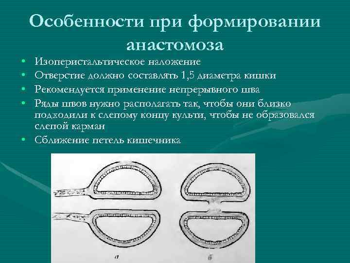  • • Особенности при формировании анастомоза Изоперистальтическое наложение Отверстие должно составлять 1, 5