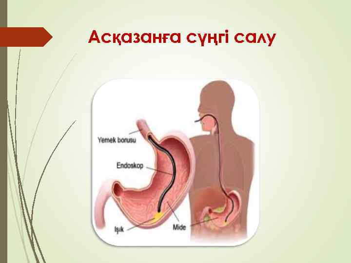 Асқазанға сүңгі салу 