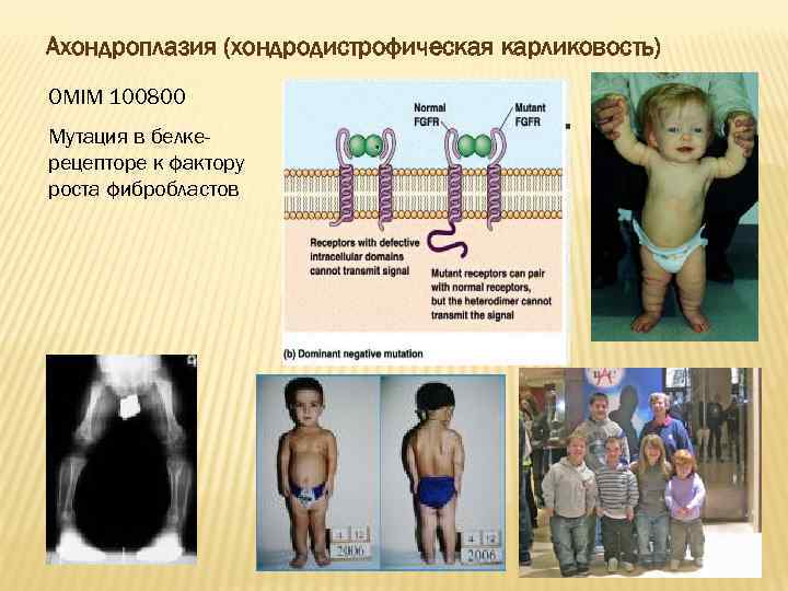 Карликовость генотип. Ахондроплазия Тип наследования. Ахондроплазия аутосомно-доминантное заболевание. Ахондроплазия фенотип. Ахондроплазия генотип.