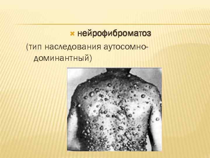  нейрофиброматоз (тип наследования аутосомнодоминантный) 