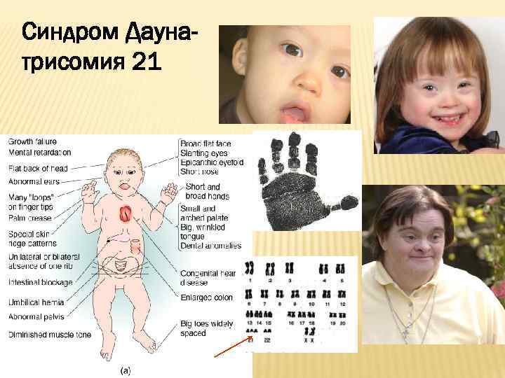 Синдром Даунатрисомия 21 
