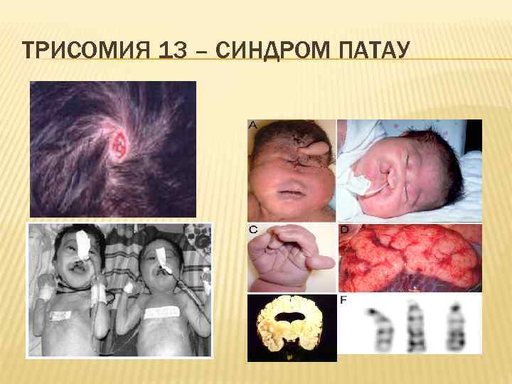 ТРИСОМИЯ 13 – СИНДРОМ ПАТАУ 
