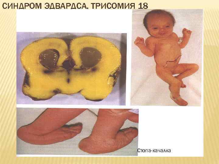СИНДРОМ ЭДВАРДСА, ТРИСОМИЯ 18 Стопа-качалка 