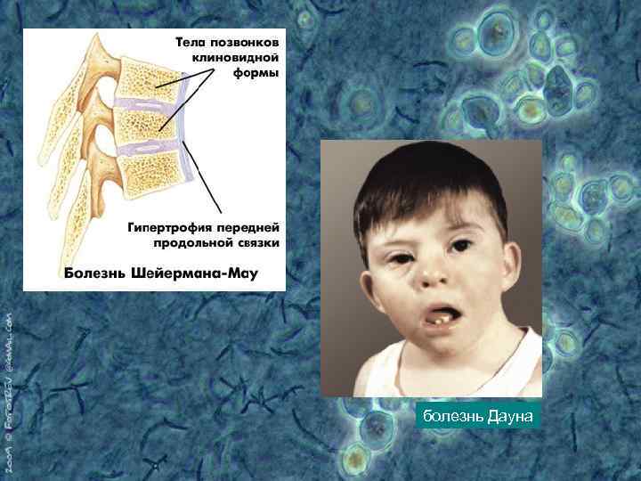 болезнь Дауна 