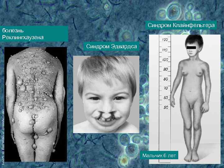 Синдром Клайнфельтера болезнь Реклингхаузена Синдром Эдвардса Мальчик 6 лет 