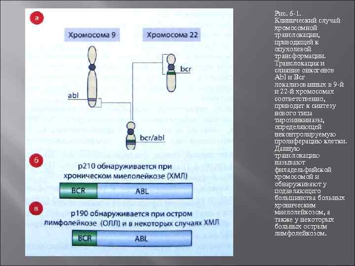 Рис. 6 1. Клинический случай хромосомной транслокации, приводящей к опухолевой трансформации. Транслокация и слияние