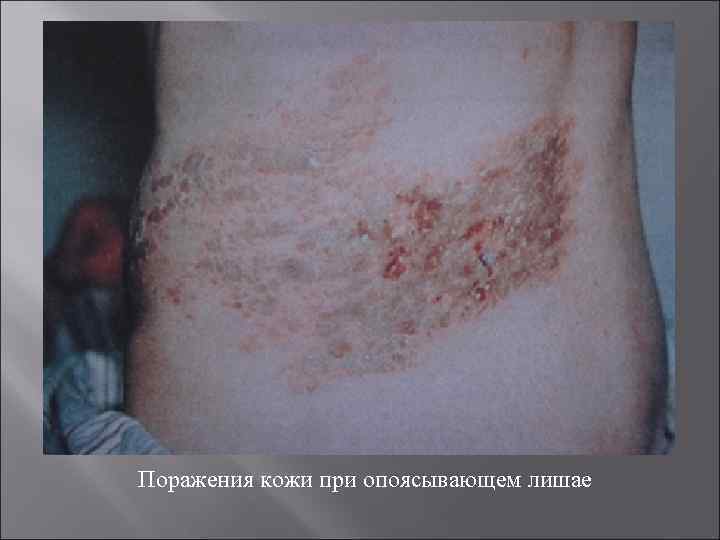 Поражения кожи при опоясывающем лишае 