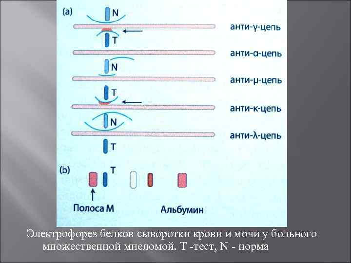 Электрофорез белков сыворотки крови и мочи у больного множественной миеломой. Т тест, N норма