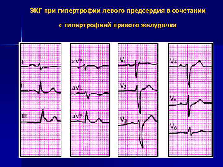 ЭКГ при гипертрофии левого предсердия в сочетании с гипертрофией правого желудочка 