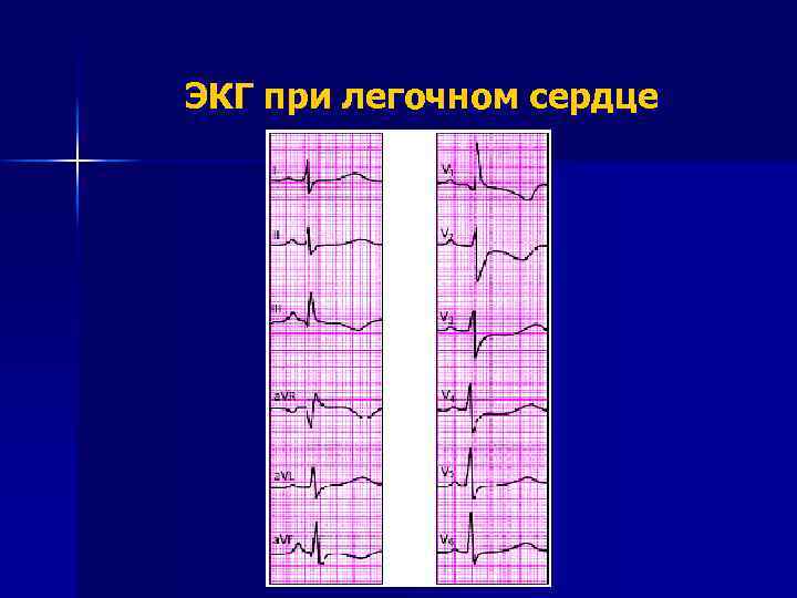 ЭКГ при легочном сердце 