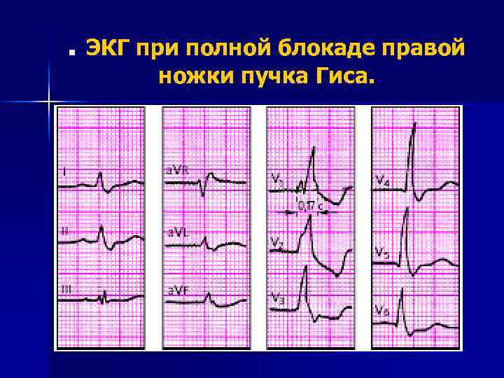 . ЭКГ при полной блокаде правой ножки пучка Гиса. 