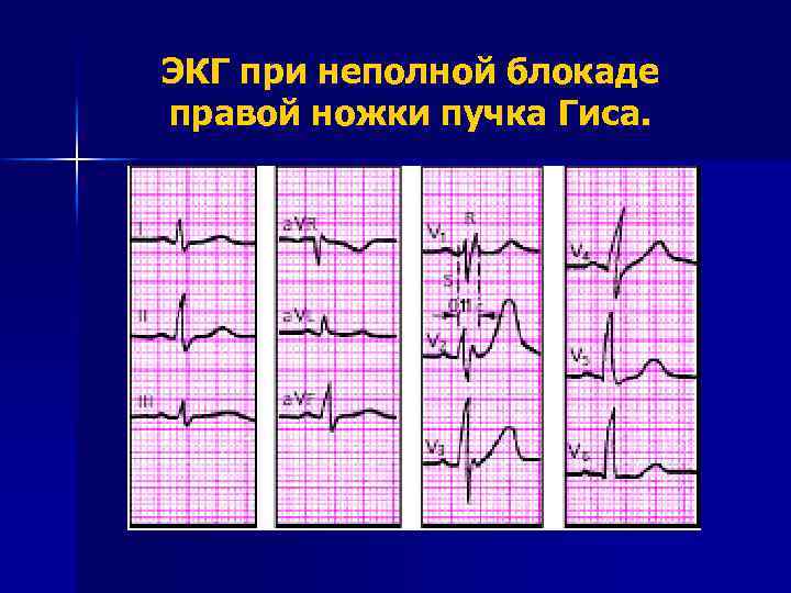 ЭКГ при неполной блокаде правой ножки пучка Гиса. 